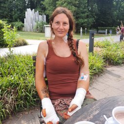 Tania Leverkusen Klinikum nach Hauttransplantation wegen Verbrennungen 3.Grades Stromunfall